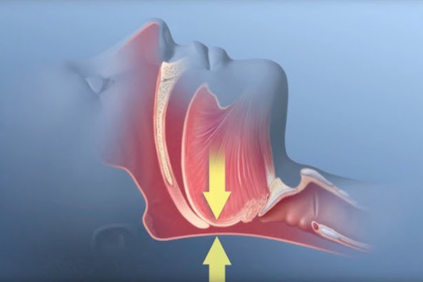 Υπνική Άπνοια Image